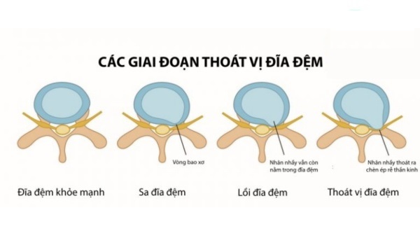 5 Dấu hiệu cảnh báo thoát vị đĩa đệm không nên chủ quan