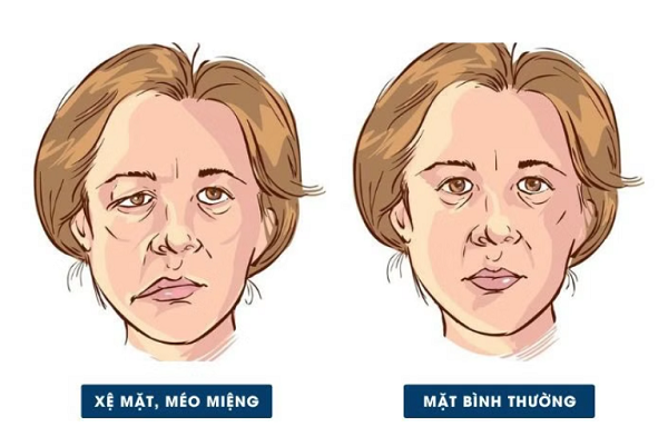 Châm cứu xoa bóp bấm huyệt trị méo miệng sau tai biến: Giải pháp phục hồi an toàn!