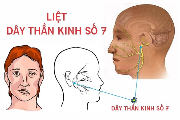 Phục hồi dây thần kinh số 7 gây liệt mặt bằng đông y: Giải pháp an toàn giúp mặt cân đối trở lại