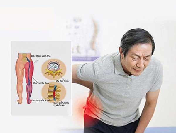 Đau thần kinh tọa là gì? Nguyên nhân, triệu chứng và cách điều trị hiệu quả?