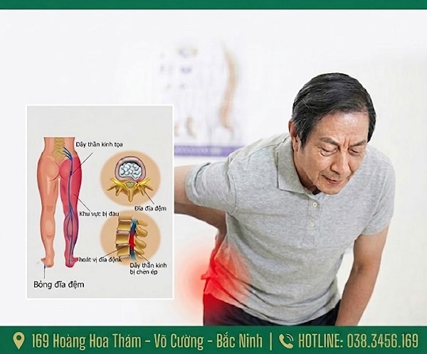 Đau thần kinh tọa là gì? Nguyên nhân, triệu chứng và cách điều trị hiệu quả?