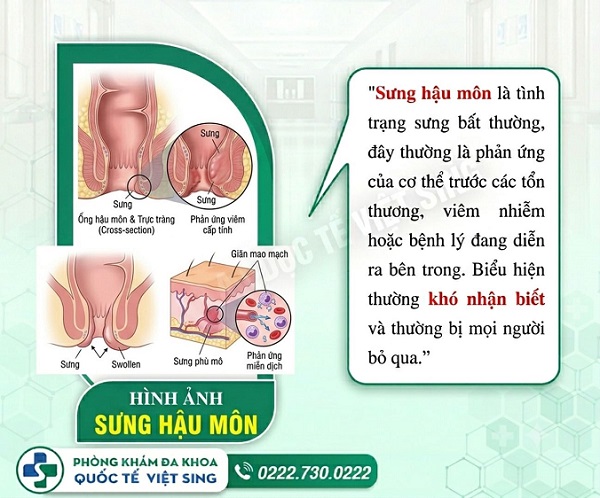 Sưng hậu môn bất thường – Cảnh báo nhiều bệnh lý nguy hiểm!