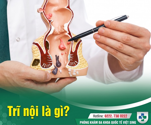 Hiểu đúng về trĩ nội: Dấu hiệu nhận biết và hướng điều trị hiện nay