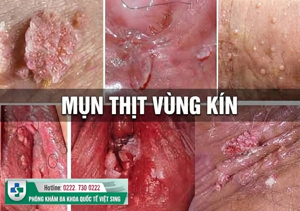 Mụn thịt vùng kín nam nữ: Nhận biết sớm – Điều trị đúng nguyên nhân