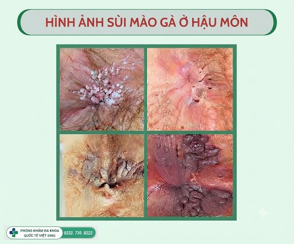 https://phongkhamquoctevietsing.vn/wp-content/uploads/2026/10/hinh-anh-sui-mao-ga-hau-mon.jpeg